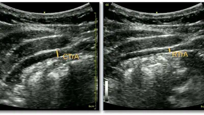 A Deep Learning Localization Method for Measuring Abdominal Muscle Dimensions in Ultrasound Images featured image
